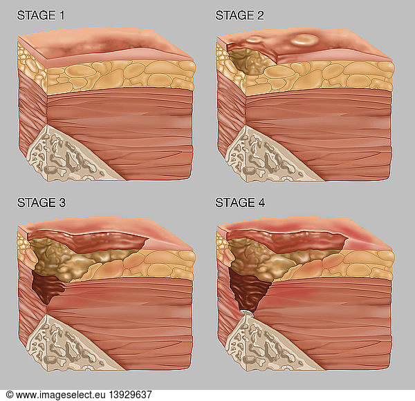 4 Stages Of A Bedsore 4 Stages Of A Bedsore Illustration Annotated Bed