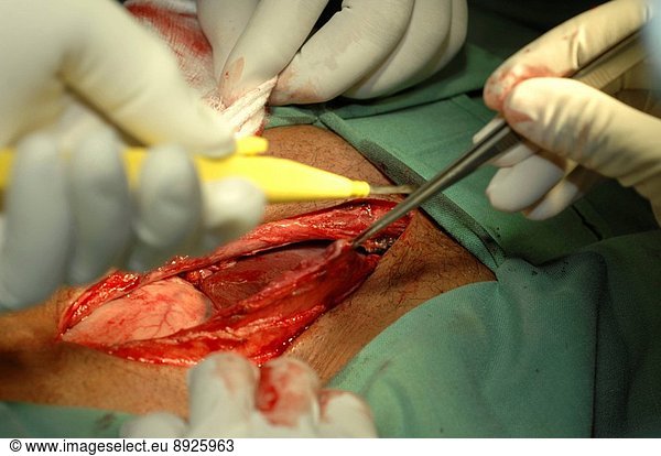 Anterior Abdominal Wall Opening Na Laparotomy Is A Surgical Procedure