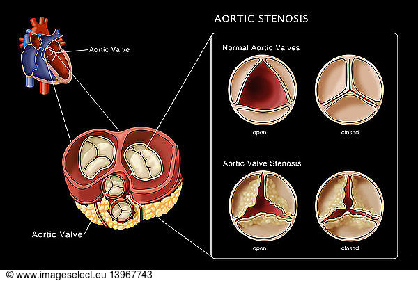 Aortic Valves Aortic Valves Normal Stenosis Illustration Abnormal