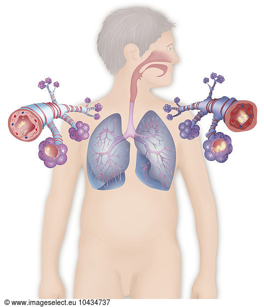 Asthma Asthma Drawing Anatomy Anatomical Alveolus Alveolar Alveoli