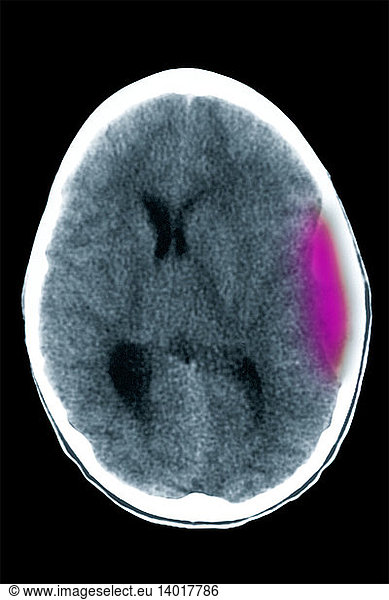 Cerebral CT Showing Subdural Hematoma Cerebral CT Showing Subdural