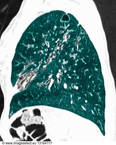 CT Scan Of Chest Showing Cystic Fibrosis CT Scan Of Chest Showing