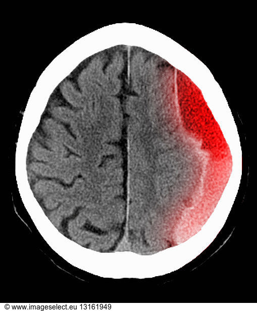 CT Scan Of The Head With Subdural Hematoma CT Scan Of The Head With