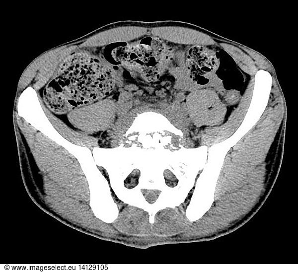 Discitis And Antibiotic Impregnated Beads Discitis And Antibiotic