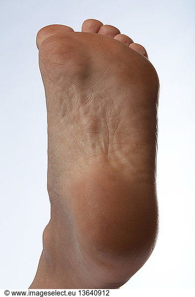 Flexed Foot Showing Plantar Fibromatosis Also Known As Ledderhose S