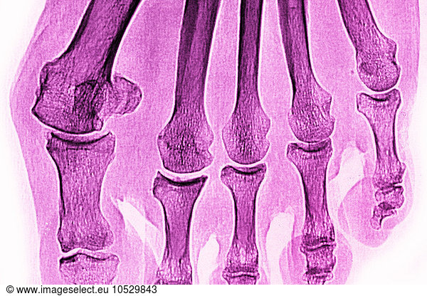 Hallux Valgus Hallux Valgus X Ray Examination Medical Examination