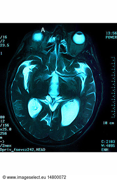 HYDROCEPHALUS HYDROCEPHALUS SCAN System Brain Hydrocephalus Imagery