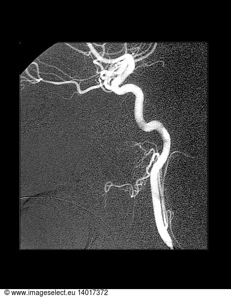 Internal Carotid Artery Internal Carotid Artery Angiogram Angiography