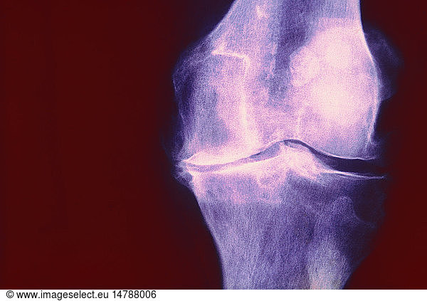 KNEE OSTEOARTHRITIS KNEE OSTEOARTHRITIS X RAY Osteomuscular Imagery