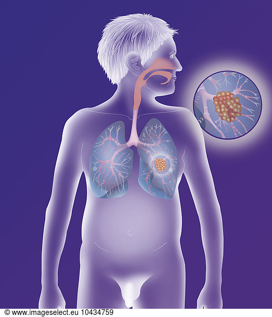 LUNG CANCER LUNG CANCER DRAWING Anatomy Anatomical Respiratory System