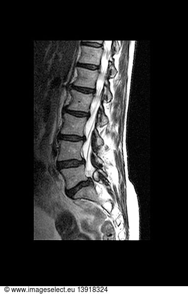 Mri Of Lumbar Spine With L S Synovial Cyst Mri Of Lumbar Spine With