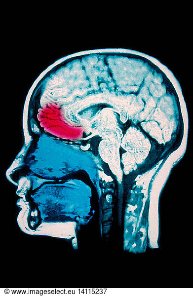 MRI Scan Of Brain Frontal Lobe Highlighted MRI Scan Of Brain Frontal