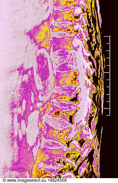 Osteoporosis With Compression Of The Dorsal And Lumbar Vertebrae