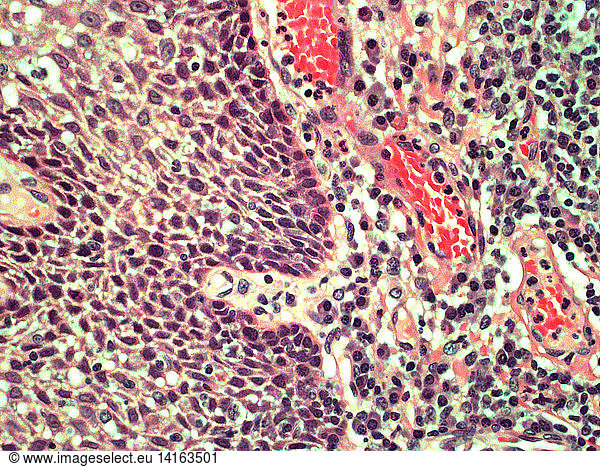 Reactive Lymph Node Reactive Lymph Node Germinal Centers LM Abnormal