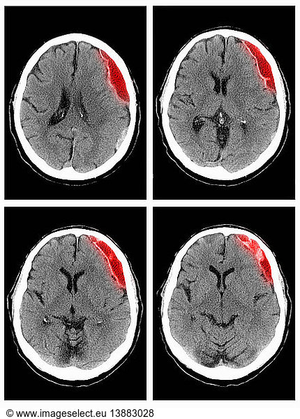 Subdural Hematoma Subdural Hematoma CT Scan Brain Scan Brain Colorised