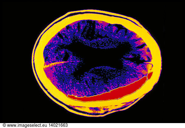 Subdural Hematoma Subdural Hematoma Blood Accumulation Brain Computed