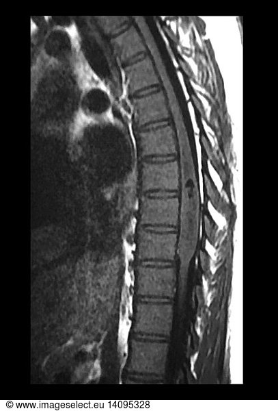 Thoracic Spinal Cord Ependymoma Thoracic Spinal Cord Ependymoma Mri