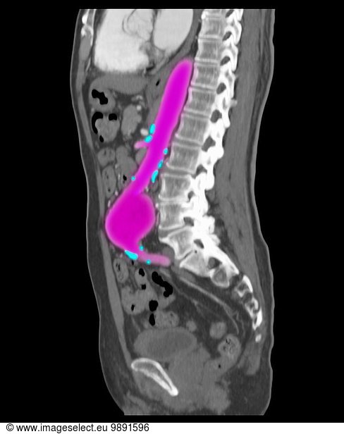 Abdominal angiographic CT scan showing a large abdominal aortic ...