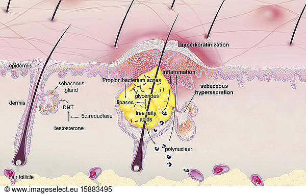 Acne around the hair follicle with inflammation Acne around the hair ...