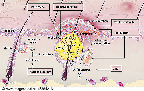 Acne around the hair follicle with inflammation Acne around the hair ...