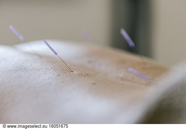 Acupuncture  acupuncture needle during treatment at back