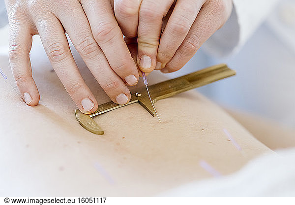 Acupuncture  hand with calliper on back with acupuncture needle during treatment