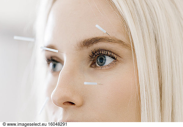 Acupuncture  young woman with acupuncture needle during treatment in the face
