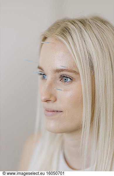 Acupuncture  young woman with acupuncture needle during treatment in the face