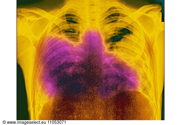 Acute bilateral pneumonia (legionnaires’ disease caused by Legionella ...