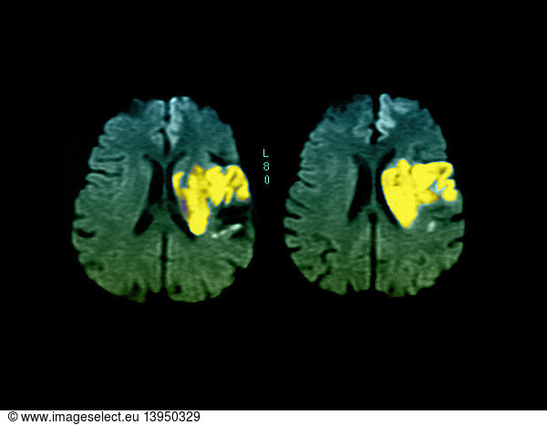 stroke-calgary-guide