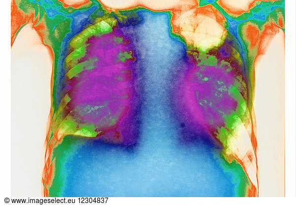 Allergic Bronchopulmonary Aspergillosis (abpa) Allergic 