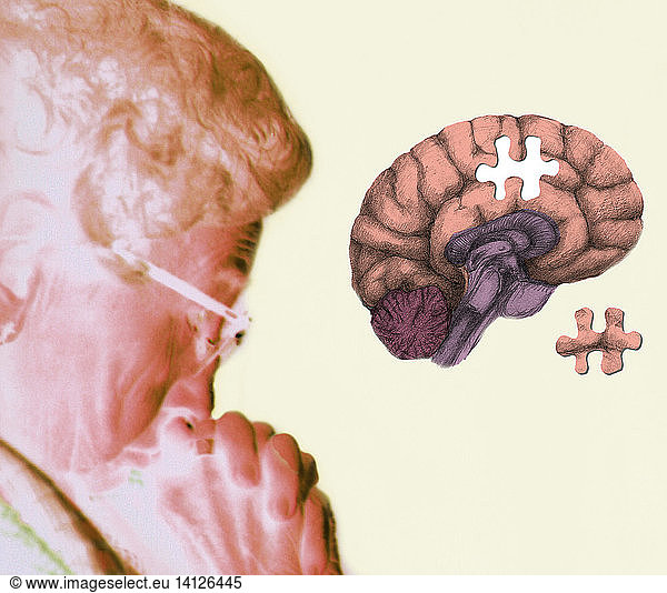 Alzheimer's Disease or Memory Loss