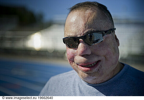 An athlete  who is covered with burn scars  stands for a portrait before track practice.