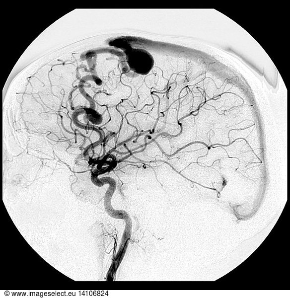 Angiogram of AV Fistula Angiogram of AV Fistula,abnormal blood vessels ...