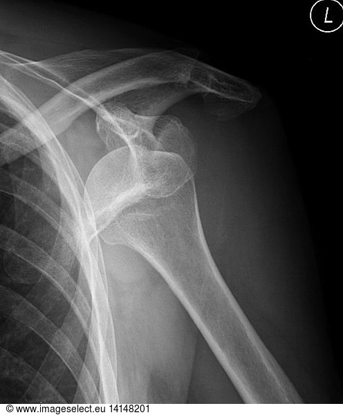 Anterior glenohumeral subluxation Anterior glenohumeral subluxation, X ...