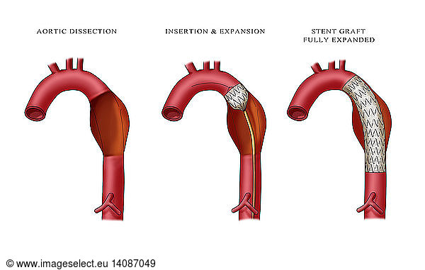 Aortic Aneurysm Stent Aortic Aneurysm Stent, Illustration,aneurism ...