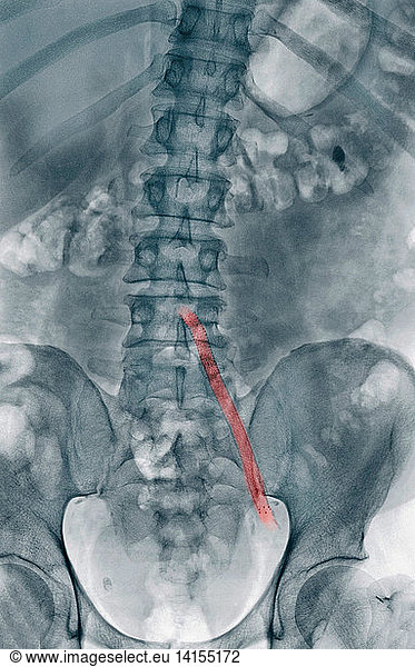 Aortoiliac Wire Mesh Bypass Graft Aortoiliac Wire Mesh Bypass Graft, X ...