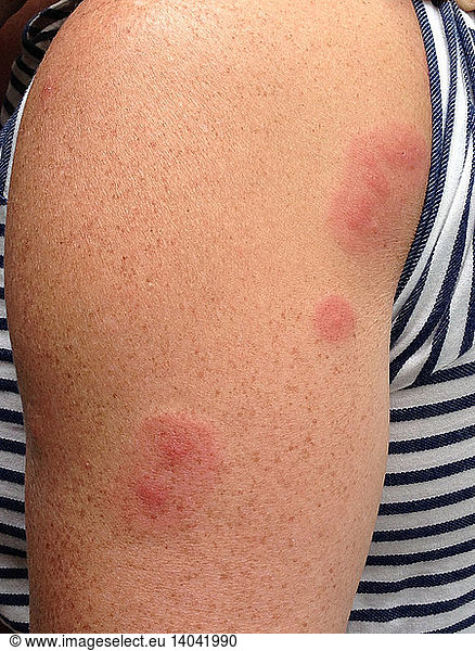 Bed Bug Bites On Arm Bed Bug Bites On Arm Bed Bug Bites Bedbug Bites Bed Bug Bites Bug Bites