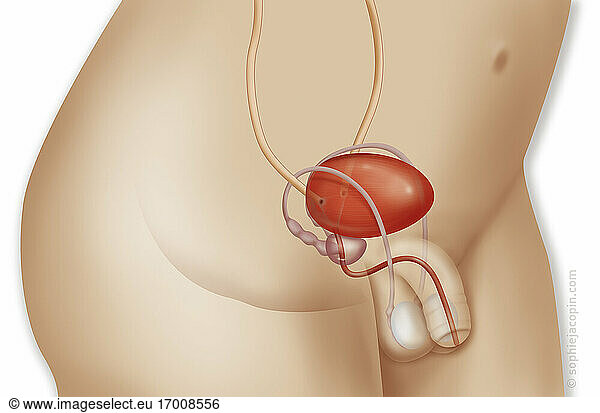Blase und ihre anatomische Beziehung zum Genitaltrakt bei einem 3-jährigen Jungen. Diese Zeichnung zeigt die Blase auf Beckenniveau und ihre Beziehung zum Genitalsystem bei einem kleinen Jungen in einer 3/4-Ansicht. Die Harnleiter (in gelbem Ocker) enden in der hinteren Wand der Blase (in Orange) mit einer Öffnung an jedem Ende des Blasentrigons. Unterhalb der Blase befindet sich die Prostata (in rosa-beige) und dahinter die Samenblasen und die Samenleiter (Vas deferens). Der Samenleiter umgeht die Blase von hinten und oben  dann von vorne und unten bis zu den Hoden (weiße Perlmuttfarbe). Die Harnröhre beginnt bei Jungen am Boden der Blase  führt durch die Prostata und endet im Penis durch den Harnröhrengang.