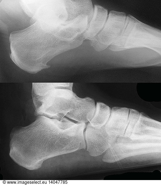 Bone Spur X Rays Bone Spur X Rays Before And After Bony Growth Heel