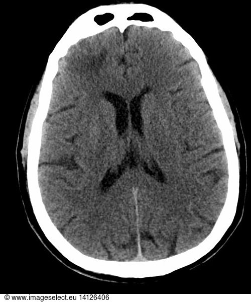 Brain Contusion Brain Contusion, CT scan,abnormal,abnormality,acute ...