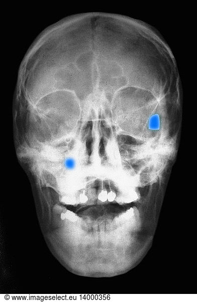 Bullet Wounds Bullet Wounds Skull X Raygungunshot Rights Managed