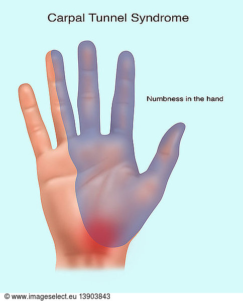 Carpal Tunnel Syndrome Carpal Tunnel Syndrome, Illustration,annotated ...