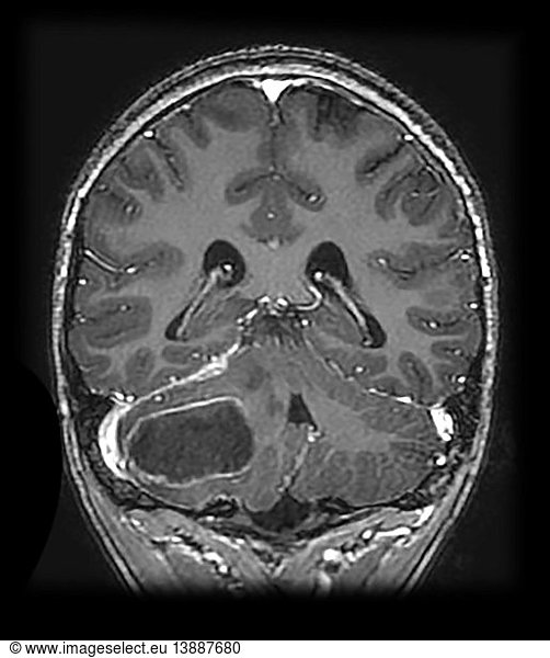 Cerebellar Abscess Secondary to Mastoiditis Cerebellar Abscess ...