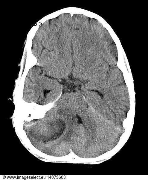 Cerebellar Abscess Secondary to Mastoiditis Cerebellar Abscess ...