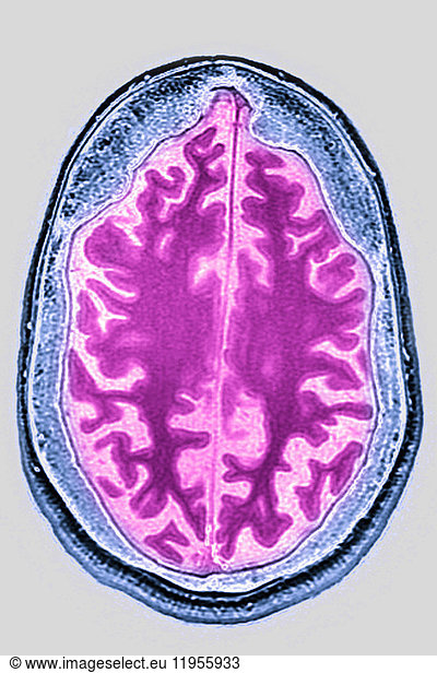 Cerebral atrophy (anterior temporal and parietal frontal ...