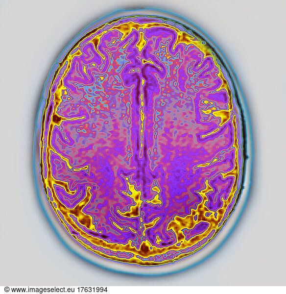 Images de neuropathology Atrophy of the brain - 23 photos et images de ...