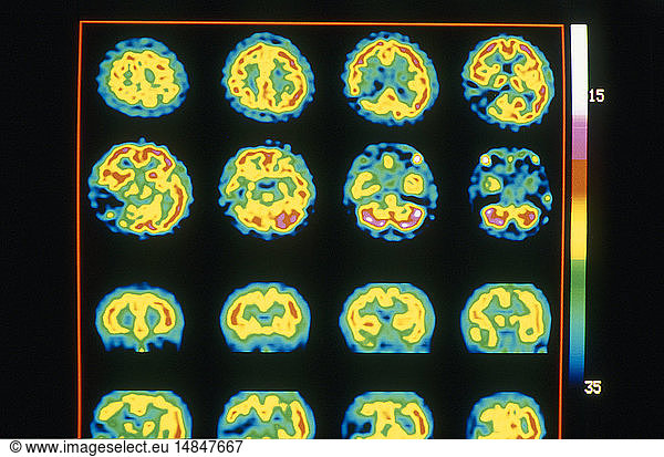 Cerebrovascular Accident Cerebrovascular Accident Scint Scint Cardio Vascular Blood Blood