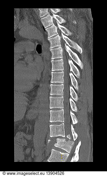 Chance Fracture of Thoracolumbar Spine  CT Scan