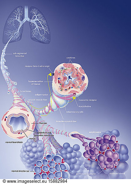 Chronic Obstructive Pulmonary Disease Copd And Its Treatments. In The 